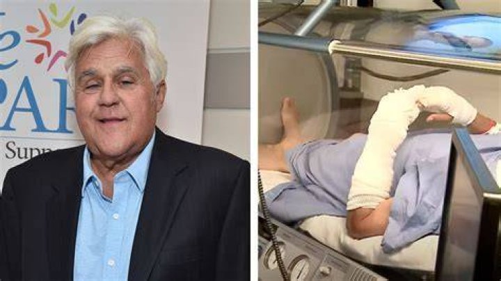 
Jay Leno Photo Burns: The Comedian Posed Following His Discharge From The Hospital 