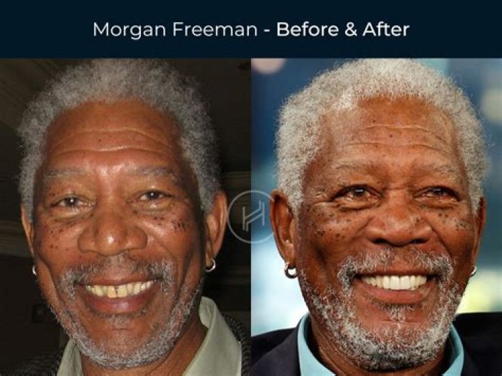 
What Is Wrong With Marvin Vettori Teeth? Before And After Photo 